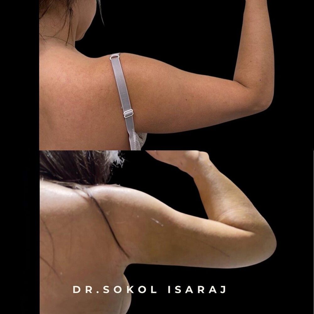 Before and After Result